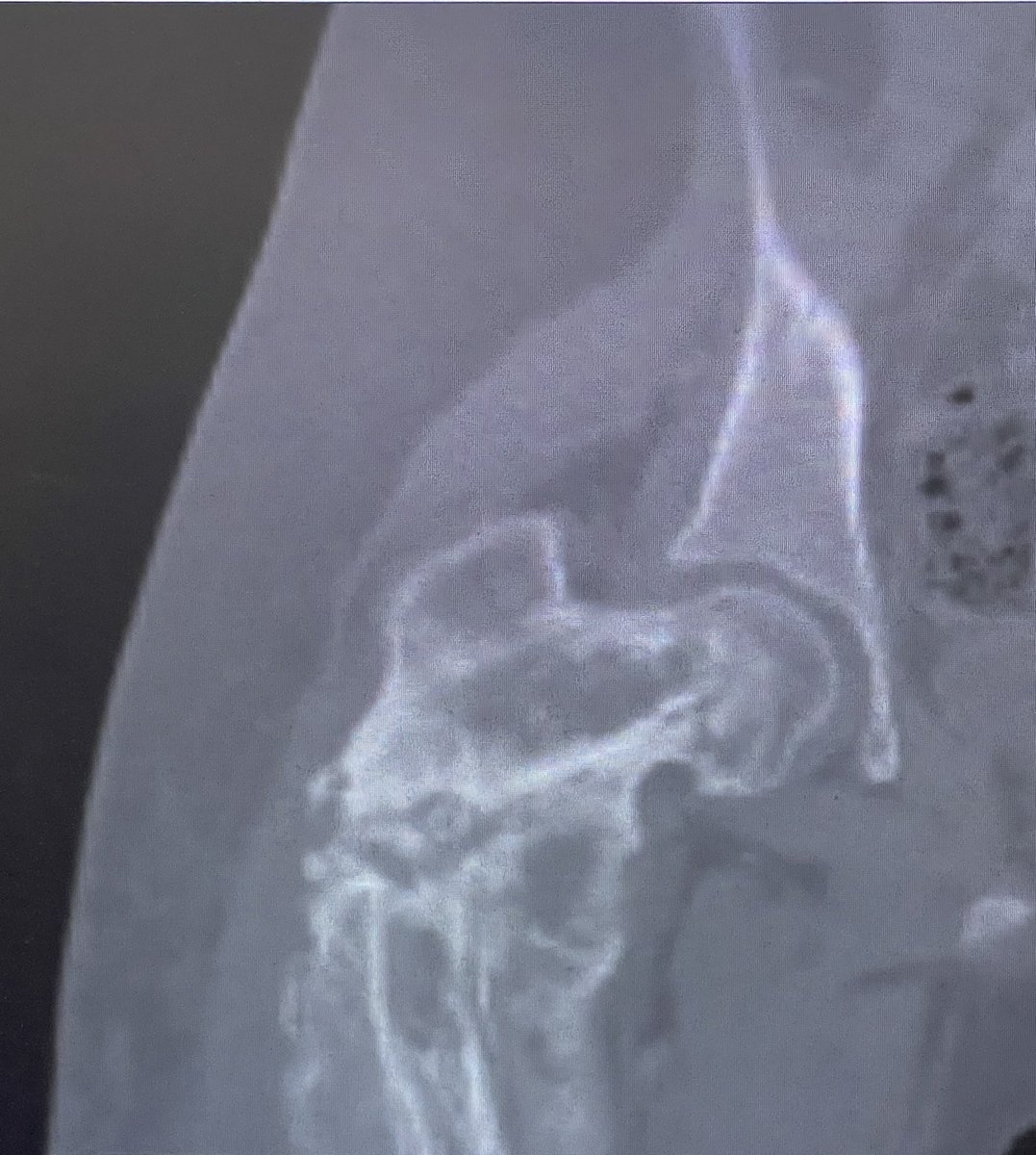 drabdullahalot's tweet photo. حالة معقدة لإستئصال ورم يوينق ساركوما Ewing Sarcoma وترميم معقد لمفصل الحوض. الحالة تمت معاينتها في العيادة وتبين أنها تم تشخيصها كحالة التهاب عضمي بالخطأ . عملت المريضة عدة عمليات خاطئة Unplanned Resections قبل الوصول إلى عيادتي. فقدت المريضة القدرة على المشي منذ ٨ أشهر قبل معاينتي لها. تم عرض خيار البتر كحل وحيد على المريضة قبل وصولها لعيادتي.

تكمن الصعوبة في مثل هذه الحالات في كون منطقة الورم ملوثة بالكامل بسبب العمليات السابقة. خيار البتر هو أحد الخيارات الشائعة التي يعمل بها لمثل هذه الحالات.

ولله الحمد والمنة، تمت مناقشة خيار الحفاظ على الطرف مع العائلة وبدأت رحلة العلاج وتكللت بالنجاح. 

الآن ولله الحمد، المريضة تشافت تماما من السرطان/الساركوما وحافظت على طرفها السفلي بشكل كامل وجميع الأعصاب والشرايين تم الحفاظ عليها . كذلك المريضة تعافت واستعادت حركة المشي ولله الحمد وفي طريقها الى أن تعيش حياة طبيعية خالية من السرطان بإذن الله.

العمل كفريق واحد كان أهم عامل لنجاح هذه الحالة. الشكر الكبير للدكتور غازي الثبيتي والدكتور عادل حلمي من جراحة التجميل على مساعدتهم في ترميم الأنسجة الرخوة للمريضة.

في الردود رابط لمزيد من الصور الإكلينيكية والشرح في حسابي بمنصة انستاقرام.

ودمتم بصحة وسلامة دائما