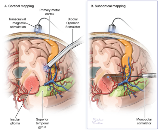 jasonpsheehan's tweet photo. A superb study in the Journal of Neuro-Oncology on intraoperative functional mapping for glioma surgery by the UCSF team. https://t.co/d1aBmrG3E8