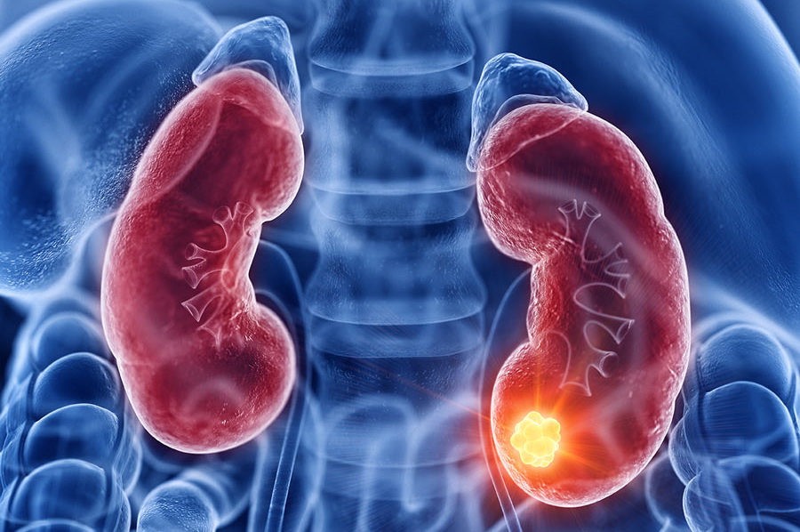 PabloFuente's tweet photo. 💊 UNA NUEVA COMBINACIÓN REDUCE EL RIESGO DE RECAÍDA EN CÁNCER DE RIÑÓN DESPUÉS DE LA CIRUGÍA
Imagina que te han operado de un cáncer de riñón y quieres evitar que vuelva. Un ensayo clínico de fase 3 con más de 1.800 pacientes demostró que añadir belzutifan al tratamiento estándar con pembrolizumab después de la cirugía mejora la supervivencia libre de enfermedad. El riesgo de recaída o muerte se redujo en un 28 % (hazard ratio 0,72), con tasas del 80,7 % a los 24 meses frente al 73,7 % con pembrolizumab solo.
Esta combinación ofrece una opción más efectiva para pacientes con carcinoma de células claras de riñón de riesgo intermedio-alto o alto después de la nefrectomía. Aunque aumentó los efectos adversos graves, representa un avance concreto para retrasar o prevenir la recurrencia.
Estudio del equipo del prof. Toni K. Choueiri en Dana-Farber Cancer Institute / Harvard, publicado en @NEJM. https://t.co/DIqKTyr5fo