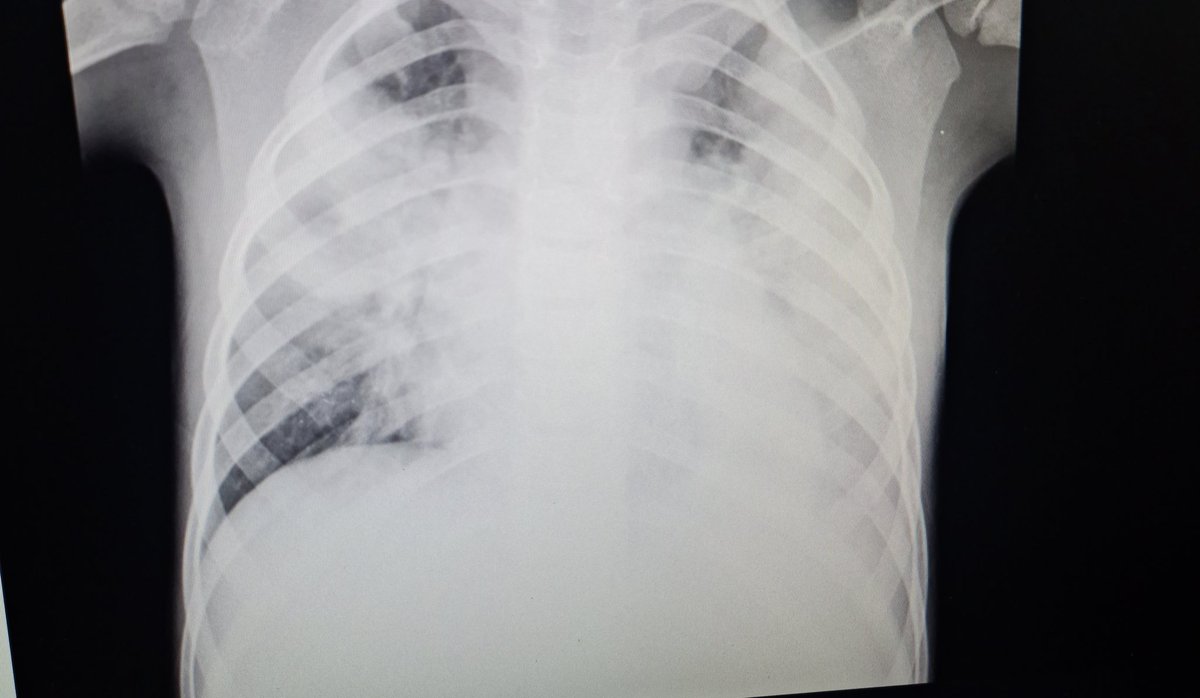 Withoutesm's tweet photo. بخاطر نداشتن هزینه بستری٫
بچهشو بااین  cxr و سچوریشن ۸۰ و رتراکشن و... برداشت برد https://t.co/ro30lsSG6d