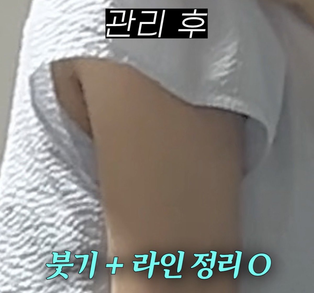 imgangji's tweet photo. 팔뚝지방흡입 약 4만원으로 했는데, 2개월 운동이랑 같이 이거 써주니까 붓기 관리엔 효과 봤어

#다이어트 #지흡패치 #팔뚝지방흡입 #지방흡입 #팔뚝붓기 #셀룰라이트제거

🔗 https://t.co/vZyqJe6joO https://t.co/HZhd4In8Hq