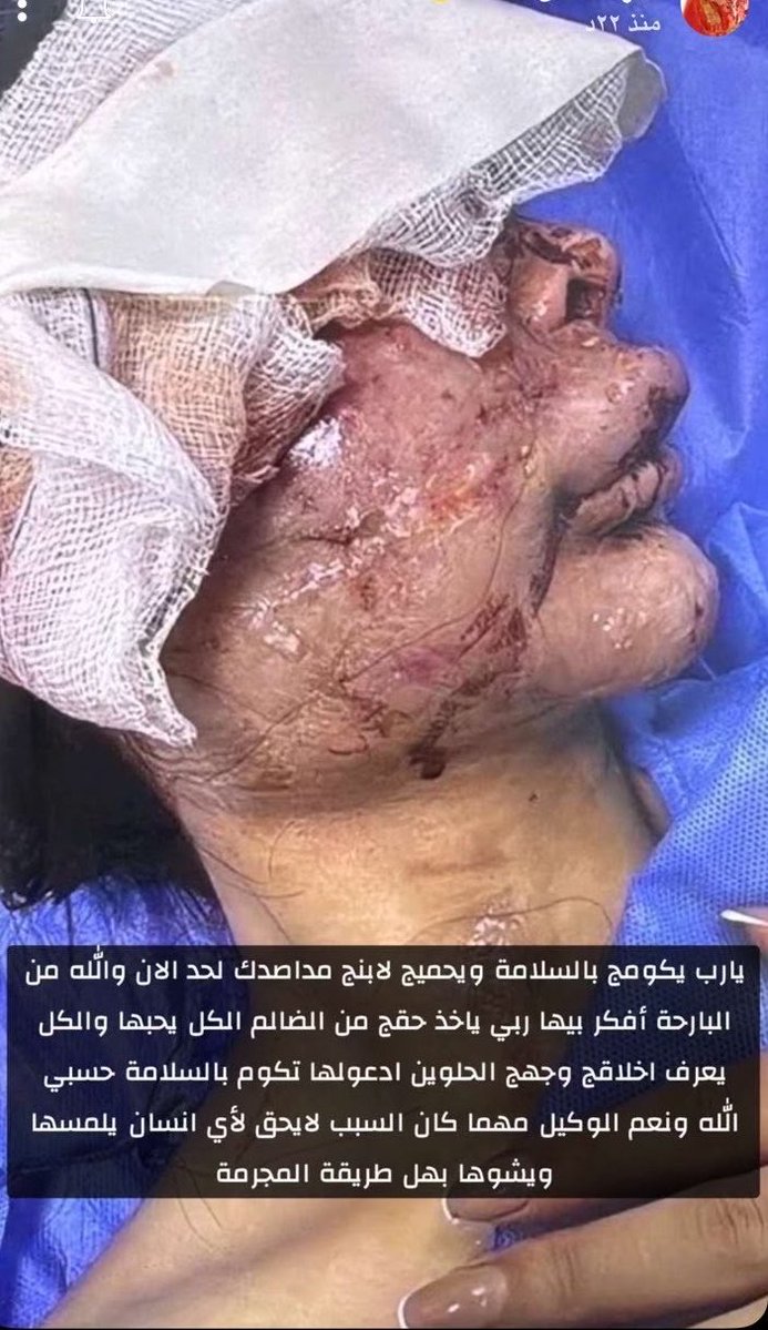 ABUdiraeaa's tweet photo. بسبب خلاف عائلي ..قيام زوج الدكتور محمد العقيدي باقتلاع عين زوجته التي تدعى  الدكتورة فيروز ويصب عليها مادة التيزاب الحارق في بغداد . https://t.co/aJzJNU3Q9f
