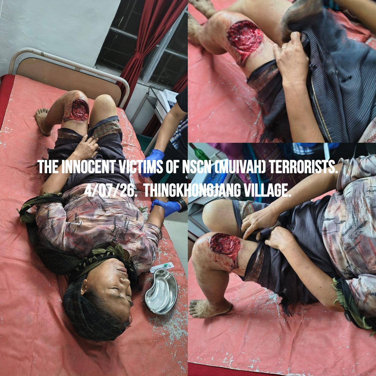 JShakurB's tweet photo. 🆘️Exactly 1 month after the NSCN (Muivah) terrorists savagely butchered a 7 month-pregnant mother & her unborn baby, the bloodthirsty predators have struck again to satisfy their insatiable lust for violence.

■Their latest targets this time is a helpless 9 year-old girl & a 56-year-old mother. Only by sheer miracle did the innocent victims survive but this latest act of Terrorism has exposed the bottomless cruelty & subhuman tactics of the NSCN (Muivah) Terrorists that preys exclusively on the defenseless.

@UNHumanRights @UN_Women @UN @UNinIndia @hrw @HRF @unwomenindia @NCWIndia @amnesty @AIIndia @CII_IWN @cii_iwnDelhi @ShekharGupta @gupta_rekha @nsitharaman @Annapurna4BJP @unwomenchief @JuliaGillard @INCMinority @BJPMinMorcha @ncsthq @NCM_GoI @UNinIndia @NCMEC @children @thewire_in  @UNICEF @UNICEFIndia @frontline_india @thewire_in @vijaita @sardesairajdeep @RahulGandhi @rajnathsingh @MukeshSinghIPS 
@LokBhavManipur @BhallaAjay26 @gpsinghips @ANI @AmitShah @PMOIndia @narendramodi @KonthoujamG @YKhemchandSingh