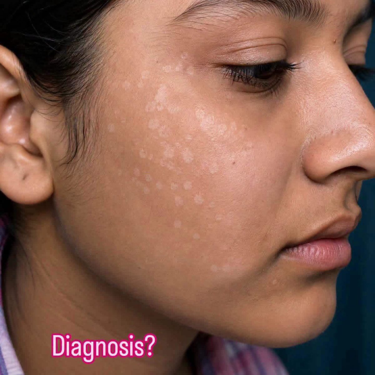 hemo_shk's tweet photo. 🩺 Spot Diagnosis (MCQ)

What is the most likely diagnosis? 

A. Pityriasis alba
B. Pityriasis versicolor
C. Pityriasis rosea
D. Psoriasis https://t.co/0p5XwkqddA