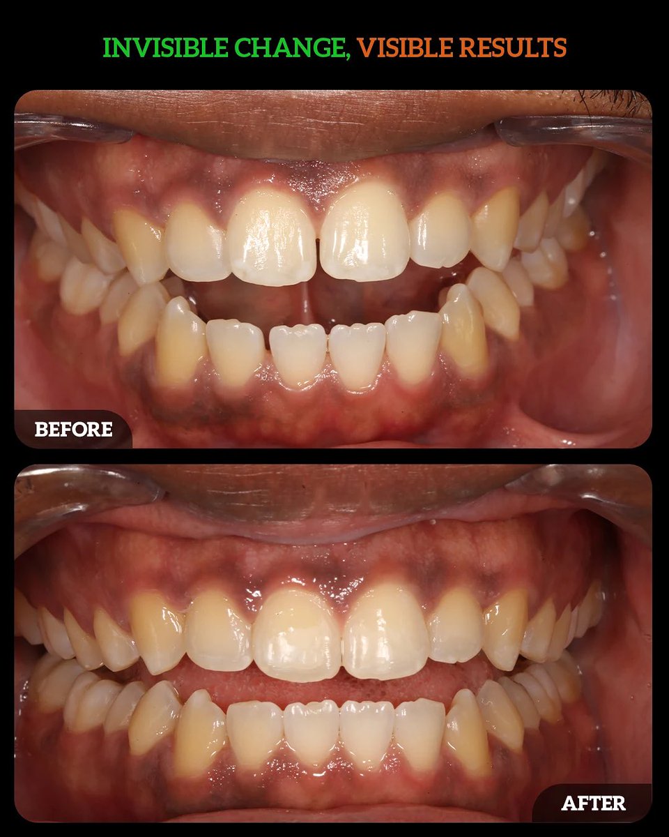 DMDGroup's tweet photo. Modern orthodontics should be precise, comfortable, and designed around the patient’s lifestyle—not the other way around
✔ Discreet treatment
✔ Comfort-focused design
✔ Digital precision
✔ Better oral hygiene
✔ Lifestyle flexibility
https://t.co/VdsB3JRtad📞(614) 766-5600 https://t.co/QvksjUTDAG