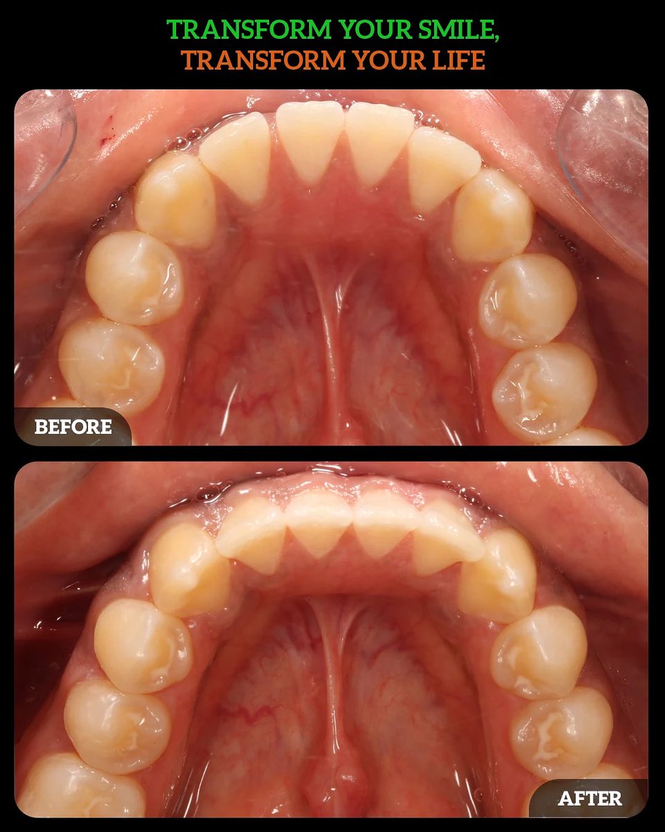 DMDGroup's tweet photo. Modern orthodontics should be precise, comfortable, and designed around the patient’s lifestyle—not the other way around
✔ Discreet treatment
✔ Comfort-focused design
✔ Digital precision
✔ Better oral hygiene
✔ Lifestyle flexibility
https://t.co/VdsB3JRtad📞(614) 766-5600 https://t.co/QvksjUTDAG