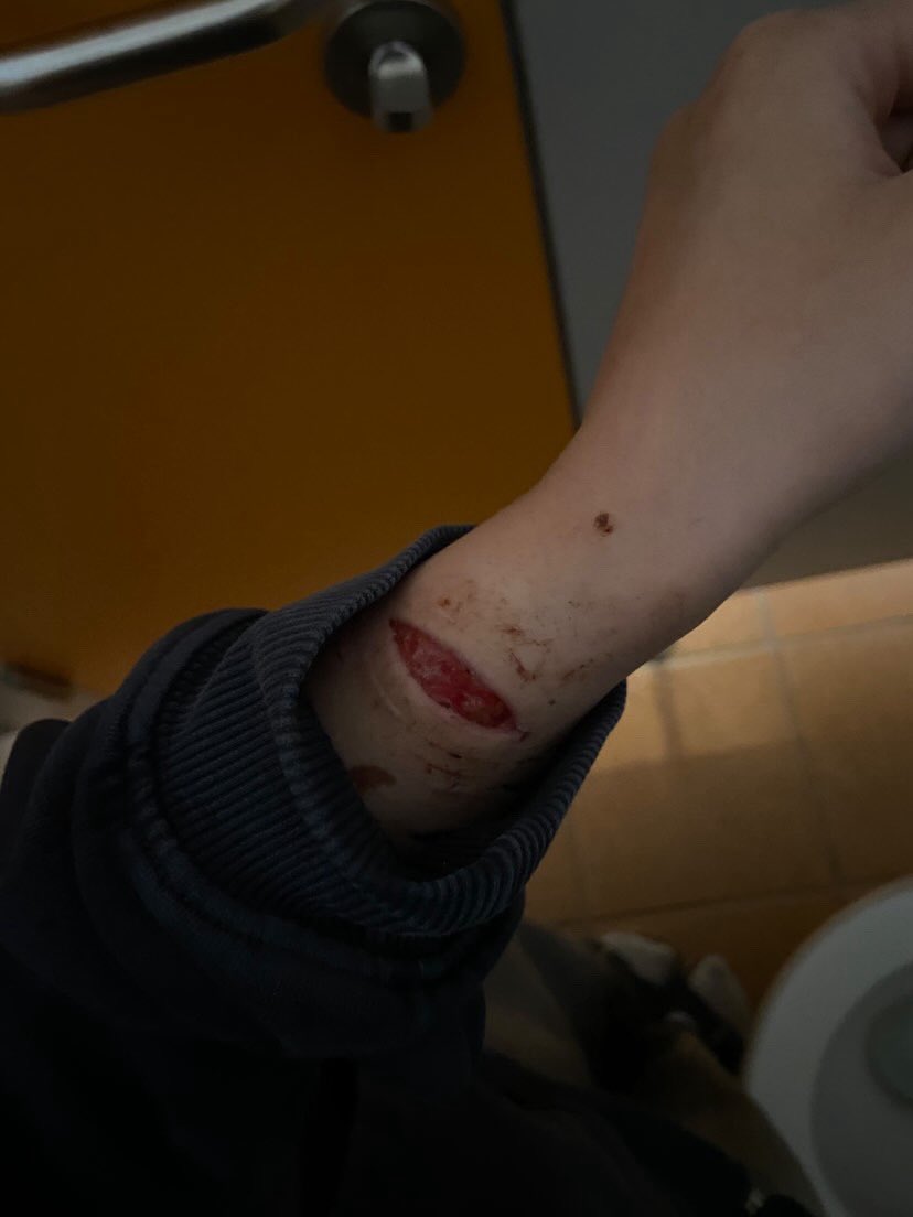 _sykk0's tweet photo. i hate how small the scar is after healing, ‘cause the wound was literally 4.2cm wide when fresh?? ( ˃̶͈̀ロ˂̶͈́)੭ꠥ⁾⁾
#shtwt #shedtwt #NOTascarspo #shame https://t.co/z2ktETHjyD