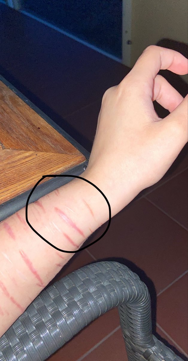 _sykk0's tweet photo. i hate how small the scar is after healing, ‘cause the wound was literally 4.2cm wide when fresh?? ( ˃̶͈̀ロ˂̶͈́)੭ꠥ⁾⁾
#shtwt #shedtwt #NOTascarspo #shame https://t.co/z2ktETHjyD