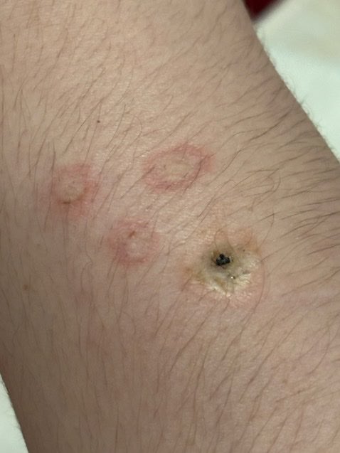 purevalorie's tweet photo. Cig burn #shtwt https://t.co/HB2bs8SSOn