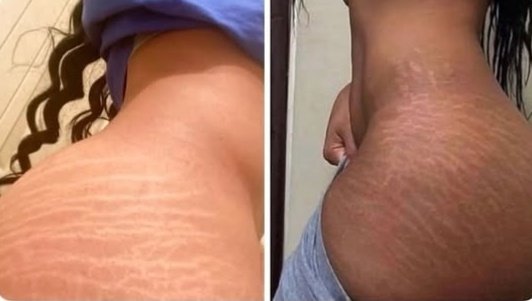 Mirema_world's tweet photo. my love for stretchmarks is top tier,unmatched for sure https://t.co/vN79hOeeaC