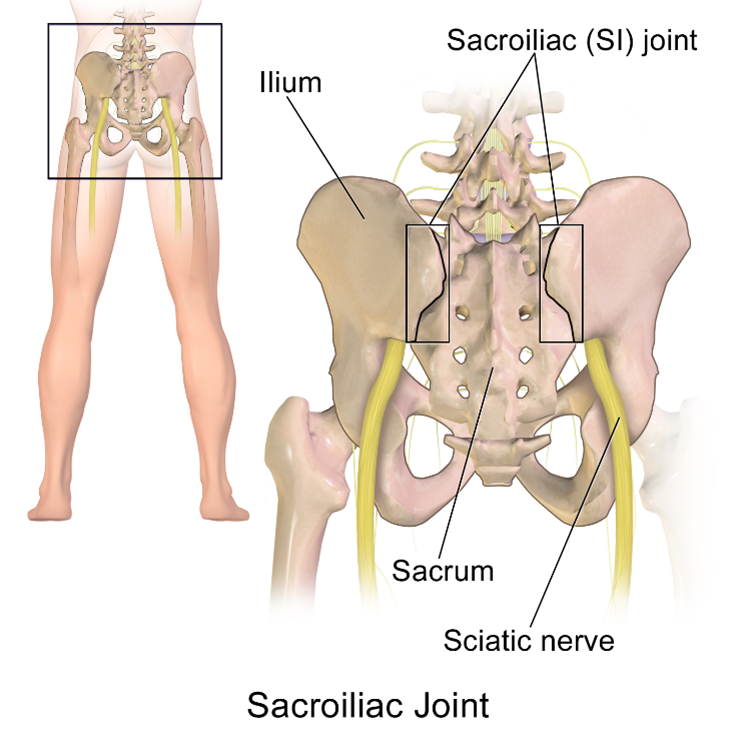 MedEd_Cases's tweet photo. The resisted abduction test helps distinguish hip pathology from SI joint pain. 

With the patient in the side lying position, the examiner passively abducts the affected hip approximately 30–45° while maintaining slight knee flexion. The patient is then instructed to actively abduct the leg against the examiner's resistance. 

Reproduction of pain that localizes to the lower back or sacroiliac region suggests the SI joint as the likely source. 

Sensitivity varies from 59-87%, specificity 87-100%.

Read: https://t.co/e0JyipudDG

Watch: https://t.co/5wKNQds6sU

#PhysicalExam #SportsMedicine #Orthopedics #PhysicalTherapy #MedicalEducation