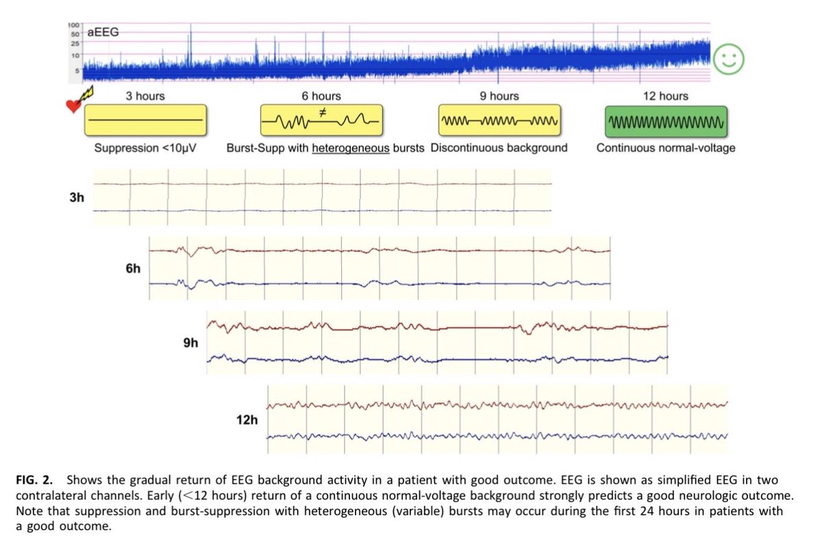 ICUAlgorithmLab's tweet photo. Prognostication after cardiac arrest: What does the latest evidence say about HIE? 🧠⚡
New review in J Clin Neurophysiol emphasizes:
✅ cEEG is king: Early continuous monitoring beats routine EEG for both good/poor outcome sensitivity.
✅ SSEP utility: Bilateral N20 absence = near 100% specificity for poor outcomes.
✅ New thresholds: Very low cortical SSEP amplitudes (~0.5 µV) are showing strong prognostic value.
Westhall et al.
Full details can be found in the article: https://t.co/7GZBcF4IV5
#NeuroTwitter #FOAMed #ICU #HIE #NeuroCritCare