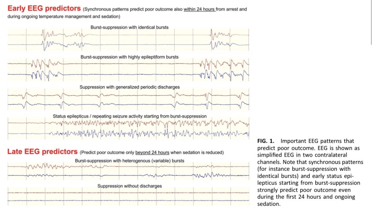 ICUAlgorithmLab's tweet photo. Prognostication after cardiac arrest: What does the latest evidence say about HIE? 🧠⚡
New review in J Clin Neurophysiol emphasizes:
✅ cEEG is king: Early continuous monitoring beats routine EEG for both good/poor outcome sensitivity.
✅ SSEP utility: Bilateral N20 absence = near 100% specificity for poor outcomes.
✅ New thresholds: Very low cortical SSEP amplitudes (~0.5 µV) are showing strong prognostic value.
Westhall et al.
Full details can be found in the article: https://t.co/7GZBcF4IV5
#NeuroTwitter #FOAMed #ICU #HIE #NeuroCritCare