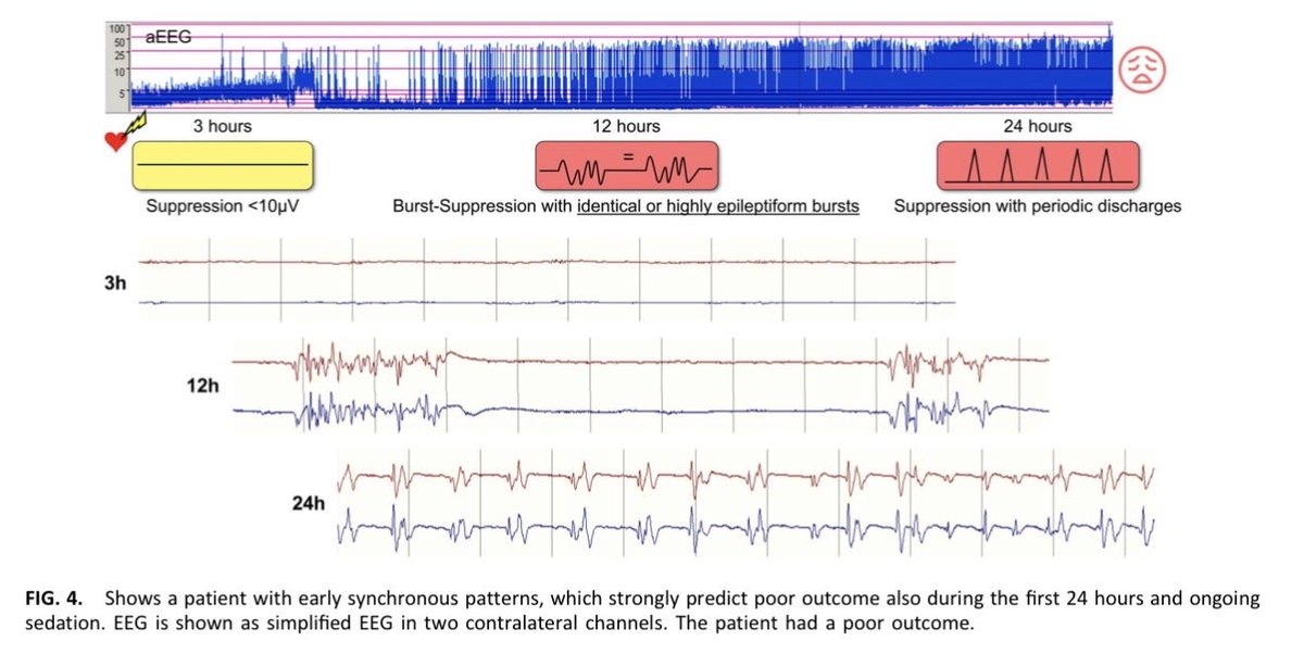ICUAlgorithmLab's tweet photo. Prognostication after cardiac arrest: What does the latest evidence say about HIE? 🧠⚡
New review in J Clin Neurophysiol emphasizes:
✅ cEEG is king: Early continuous monitoring beats routine EEG for both good/poor outcome sensitivity.
✅ SSEP utility: Bilateral N20 absence = near 100% specificity for poor outcomes.
✅ New thresholds: Very low cortical SSEP amplitudes (~0.5 µV) are showing strong prognostic value.
Westhall et al.
Full details can be found in the article: https://t.co/7GZBcF4IV5
#NeuroTwitter #FOAMed #ICU #HIE #NeuroCritCare