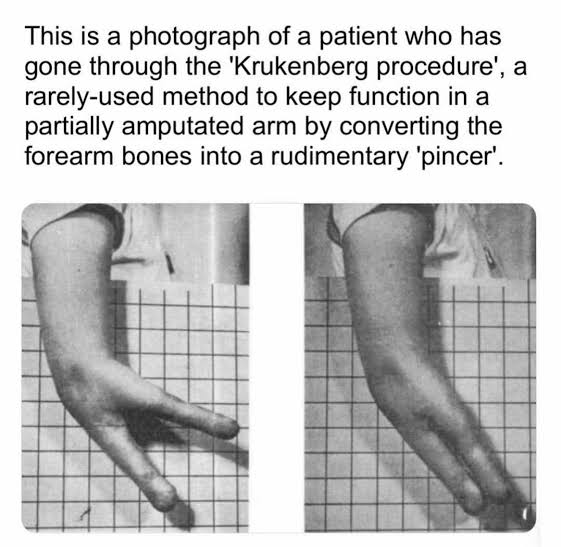 KilValmer's tweet photo. remember: if you accidentally blow off your hands with fireworks, theres always the Krukenberg procedure... https://t.co/4hQzGgxClZ