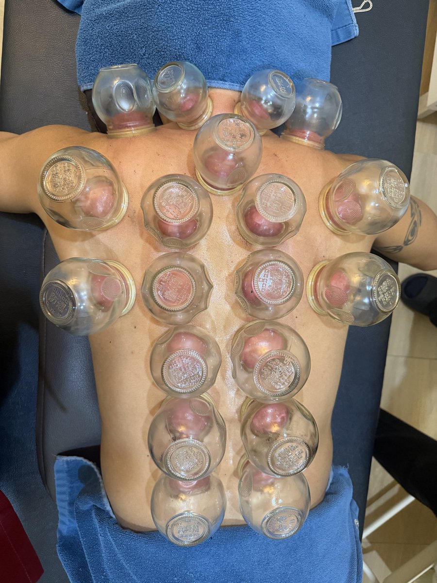 PainawayB's tweet photo. カッピング＝跡をつけるだけではありません。

皮膚を持ち上げることで血流を促し、筋膜や筋肉の滑走性を改善し、身体の動きをサポートします。

肩こり、腰痛、スポーツ後のコンディショニングにも活用されています。

#カッピング #筋膜リリース #肩こり #腰痛 #コンディショニング #PainAwayClinic https://t.co/rmimu1T43r