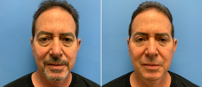 CosmetiCare's tweet photo. Before and after of an Upper/lower bleph with fat transfer✨

Schedule your consultation with one of our Board-Certified plastic surgeons today by calling 949-446-1542! https://t.co/D4d2pJovyW