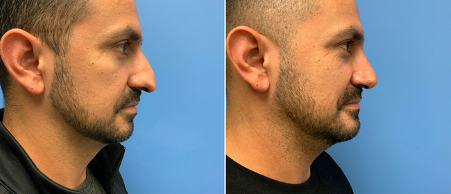 CosmetiCare's tweet photo. Before and after of a Rhinoplasty! ✨

Schedule your consultation with one of our Board-Certified plastic surgeons today by calling 949-446-1542! https://t.co/3pcoTQo9TR
