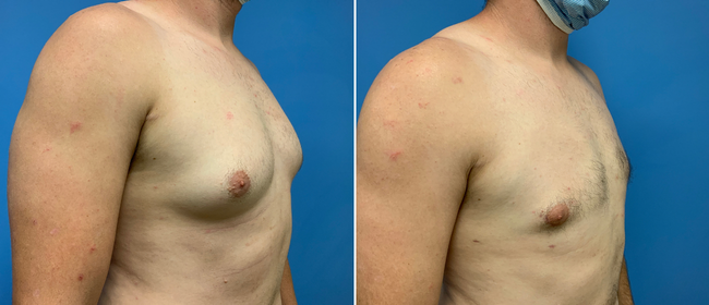 CosmetiCare's tweet photo. Before and after of a Gynecomastia ✨

Schedule your consultation with one of our Board-Certified plastic surgeons today by calling 949-446-1542! https://t.co/Q86j1G0kj3
