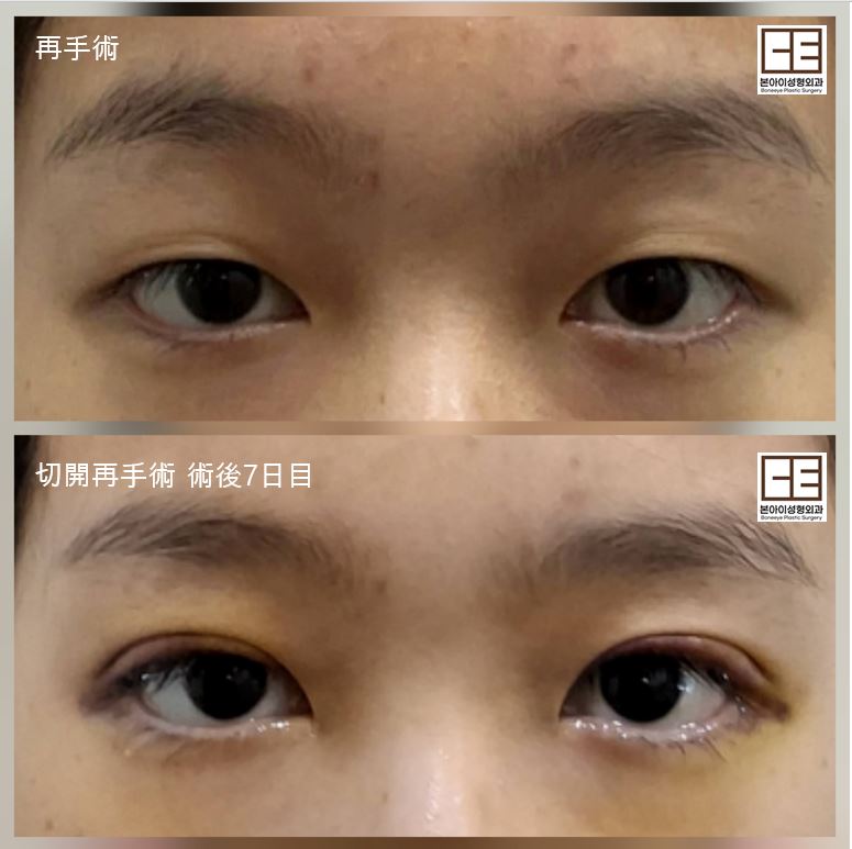 boneeyeps's tweet photo. 💘ボナイ整形外科 切開 再手術💝
▶️切開 再手術
気になることございましたらいつでも
公式LINEにご連絡ください💌
https://t.co/L32y87w6Yn

再手術も得意とする病院です！！
ボナイ整形外科で大変🫶🏻

#韓国　#整形 #ボナイ整形外科 #切開 #二重 https://t.co/gZpFifVLh2