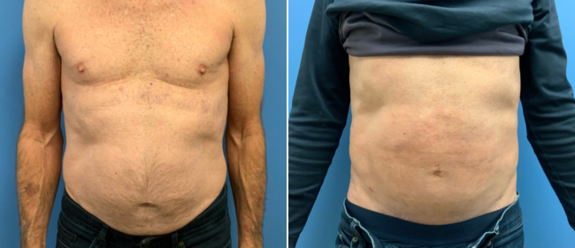 CosmetiCare's tweet photo. Before and after of Liposuction ✨

Schedule your consultation with one of our Board-Certified plastic surgeons today by calling 949-446-1542! https://t.co/V8Y3WRKEwq