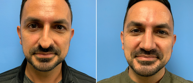CosmetiCare's tweet photo. Before and after of a Rhinoplasty! ✨

Schedule your consultation with one of our Board-Certified plastic surgeons today by calling 949-446-1542! https://t.co/tDqKXWbbrN