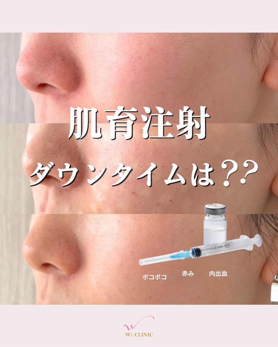 wiclinicpr's tweet photo. ＼肌育注射のダウンタイムは？👀／

気になっているけれど
ダウンタイムが不安…という方へ💭

気になる経過を
分かりやすくご紹介します✨

ぜひ画像をチェックしてください🫧

#ウィクリニック #ウィクリニック吉祥寺院
#肌育注射 #肌育 #美容医療 #美肌治療 https://t.co/bRbCrmgOk3