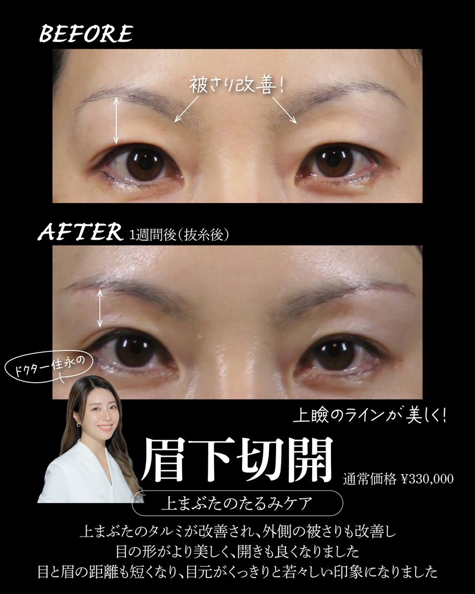 Rejuva3's tweet photo. 住永先生の
≪眉下切開≫

上瞼のタルミが気になってきたら、眉下切開の適応かもしれません
眉の下のラインで切開し、たるんだ皮膚を切除することでタルミを改善する手術です

気になる方は是非カウンセリングにお越しください☺

ご予約はこちらから
LINE@rejuva
https://t.co/CAmIyUYc8G https://t.co/RKq8QKKNAY