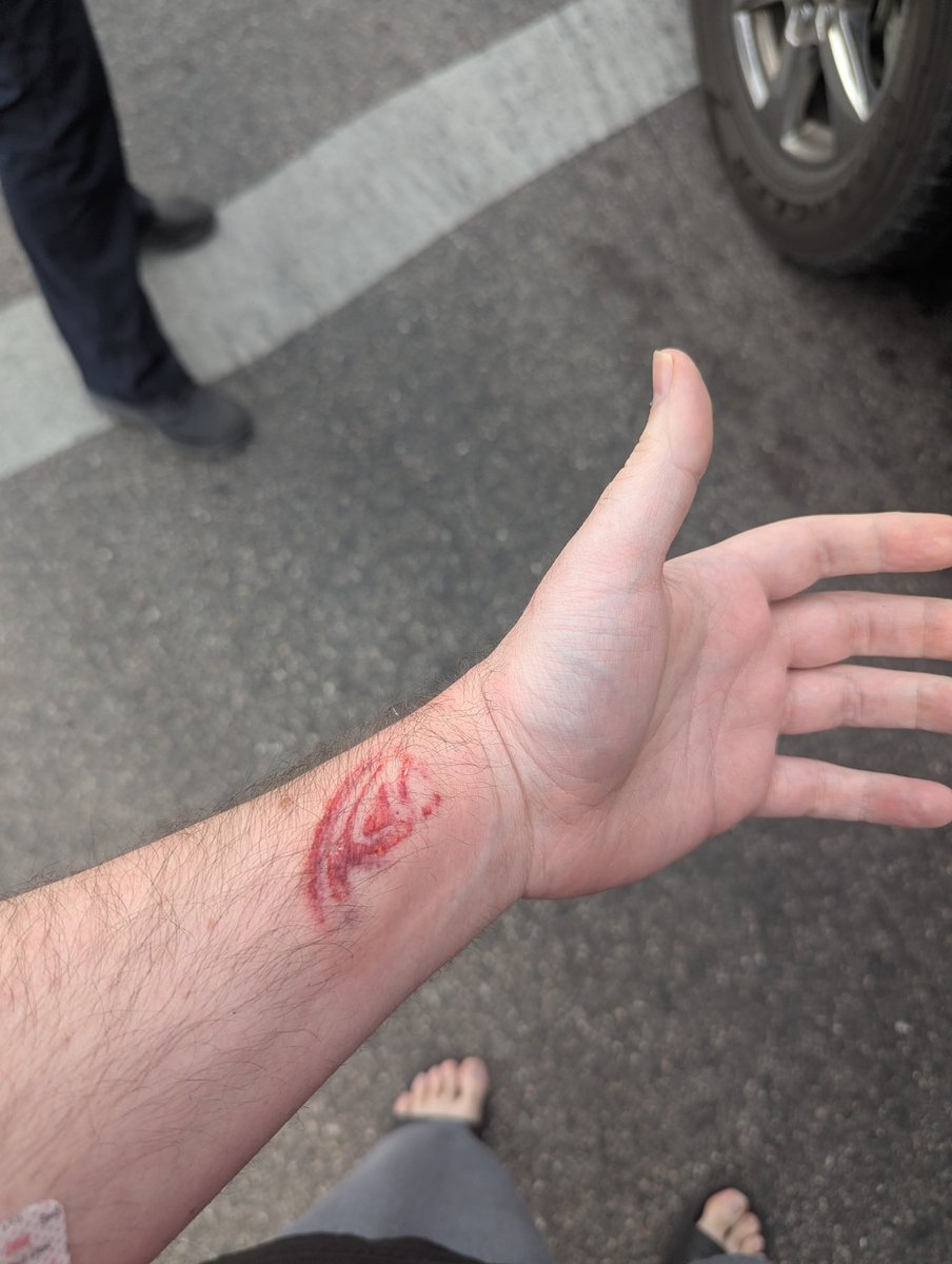 JonnyyRage's tweet photo. Hey @Toyota thank you for making such a safe car. Person cut in front of me at a light for a left hand turn. Their fault and I tboned them. 

But look @Toyota the airbag branded me with the Toyota emblem. 🤣😳 https://t.co/NBMUEkuwhE