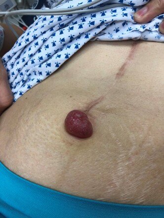 Dr_BosanFrancis's tweet photo. A patient presents with a firm umbilical nodule found to be a metastatic lesion from an intra-abdominal malignancy.
What is this finding called?

A. Sister Mary Joseph nodule 
B. Virchow's node
C. Courvoisier sign
D. Grey Turner's sign https://t.co/IWhn1NIKNB