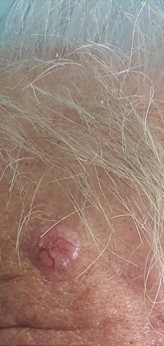 SamoJa1504's tweet photo. Da ne bude da pišem samo o melanomu, evo malo i o bazocelularnom karcinomu ķože (BCC)
To je najčešći karcinom kože, i uopšte najčešći karcinom kod ljudi... 
Nastaje kao posljedica štetnog UV zračenja, najčešće  na dijelovima koji su fotoeksponirani (lice, uške, ramena, ruke...)
Izuzetno rijetko metastazira i to mu je "dobra" osobina... 
Ali ima lokalni destruktivan rast, tj "jede" tkivo oko sebe i ispod sebe....
Pošto se najčešće sreće kao mala ranica koja povremeno krvari, ili kao crvenkasti čvorić ljudi ga ignorišu dok ne krene da pravi ozbiljnu štetu...
Terapija je hirurška i vrlo uspješna...
 Dva primjera kako može izgledati: 
#BCC #basalioma #SPF