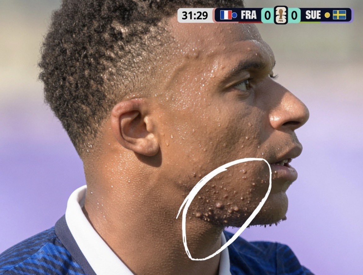 ilobest1996's tweet photo. Hey @grok, what is the name of the health condition appearing on Mbappé's chin? https://t.co/xnbqQIWvsK