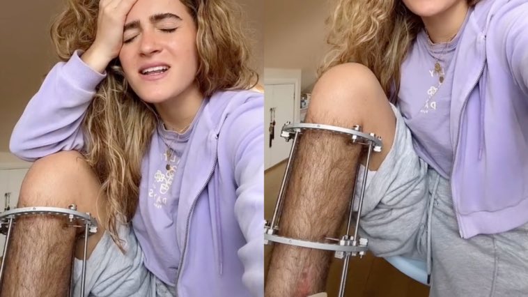 EIGHTSVOICE's tweet photo. la scelta della depilazione è talmente libera che qualche anno fa questa povera ragazza è andata virale per la marea di insulti ricevuti perché CON DEI CAZZO DI FERRI INFILATI NELLA GAMBA non si poteva depilare https://t.co/s1HM3sm4I3
