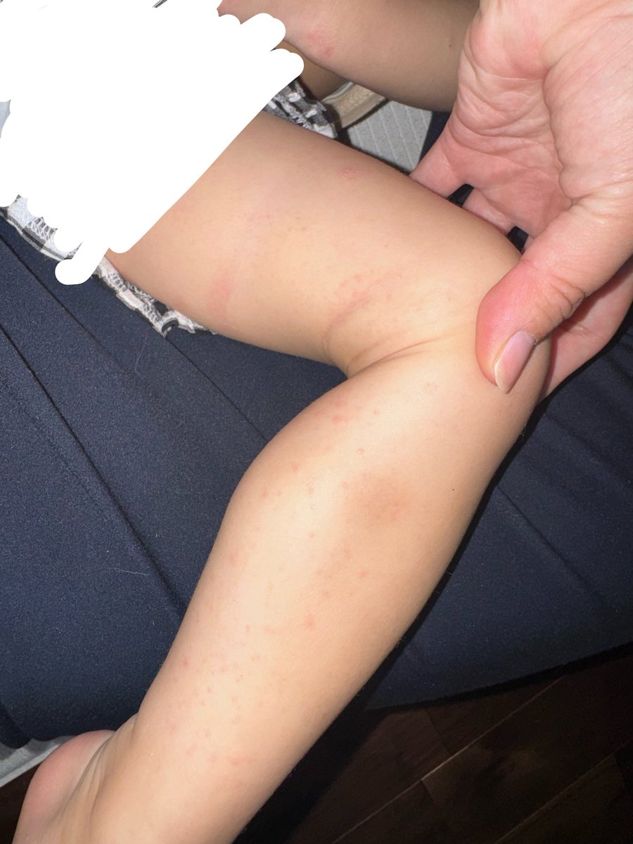 hhhna__k's tweet photo. 娘、水曜から発熱で日曜やっと解熱
謎の不機嫌がずっと続いてて
今日保育園から帰ってきたらこれ
手足口病？！？！かと思ったら
２歳半にして突発だったー😭 https://t.co/BBdAFlJDZK