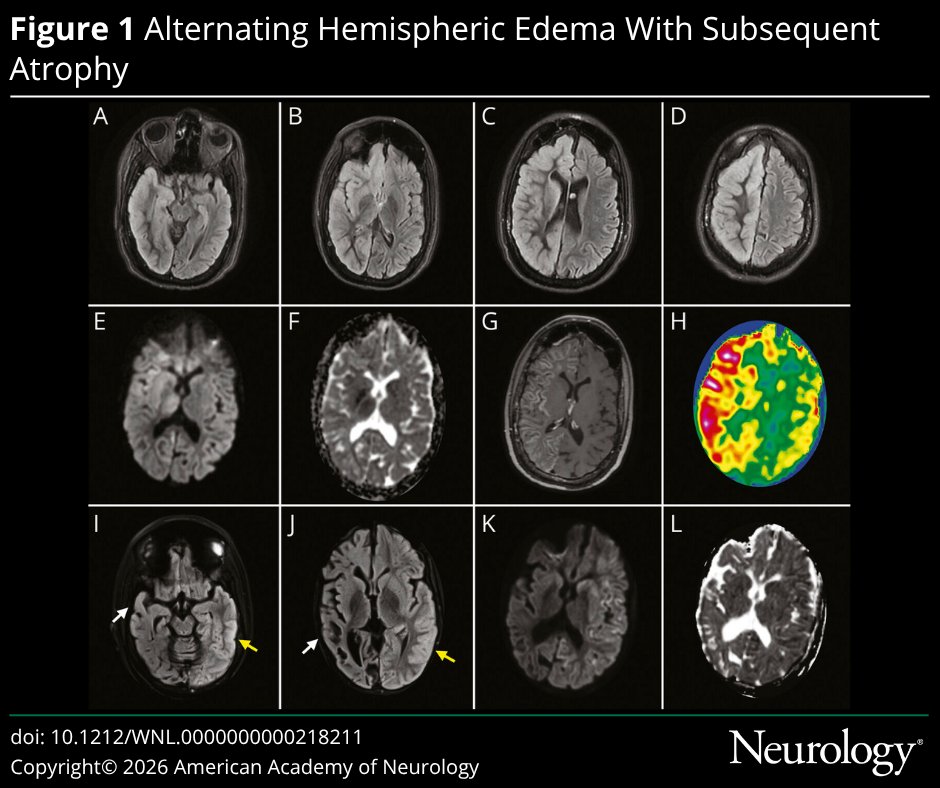 GreenJournal's tweet photo. This neuroimage depicts recurrent alternating hemispheric edema in RHOBTB2-related disease. Read more: https://t.co/ZnN7Ia5XW4 https://t.co/XYbsL4fjqK