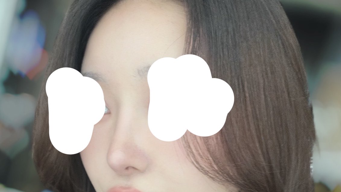 datusunako's tweet photo. 鼻フル(プロテ有、肋軟骨)から約9ヶ月経ちました👃♡ https://t.co/zly6xAifDN