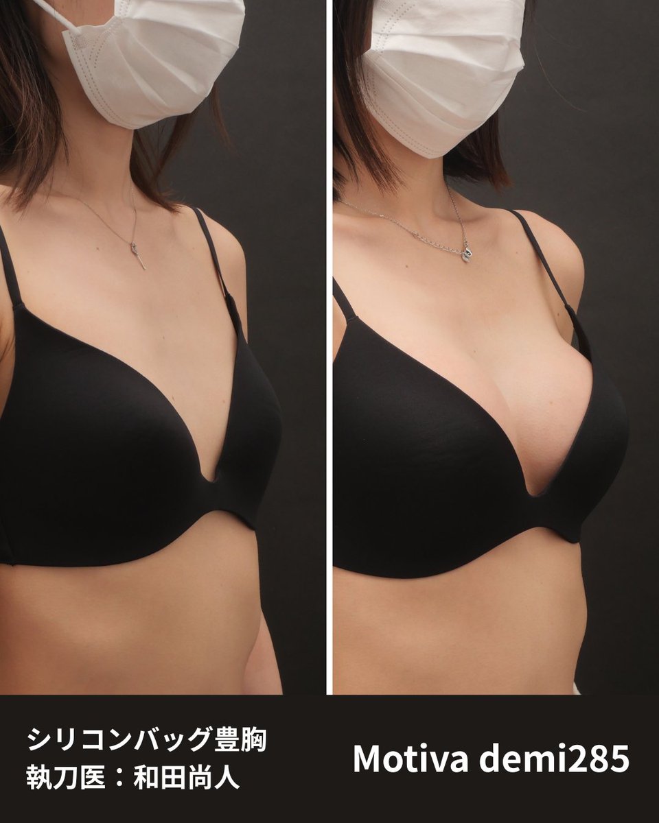 wada_isea's tweet photo. 「細身の方に285ccは、大きすぎませんか？」

身長158cm・BMI18.8、Bカップの患者様。

当初はDカップ程度をご希望でしたが、カウンセリングを重ね、最終的にはEカップ前後、約3カップアップを目指す方針になりました。

デコルテにはやや痩せ感がありましたが、 https://t.co/MqfNVAmFdV