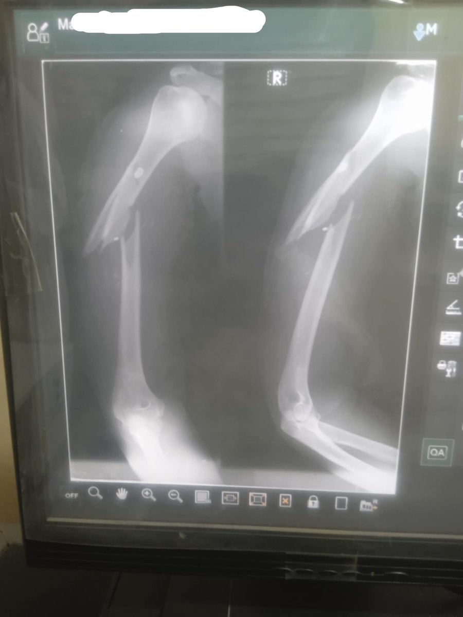 noeleeisaround's tweet photo. These are photos of a woman who was sexually and physically assaulted by the UAE-backed Rapid Support Forces.

She requires surgery for a fractured arm and is also suffering from multiple broken ribs.

Your donations help us provide lifesaving support to survivors like her. https://t.co/dlD2SuHkvR