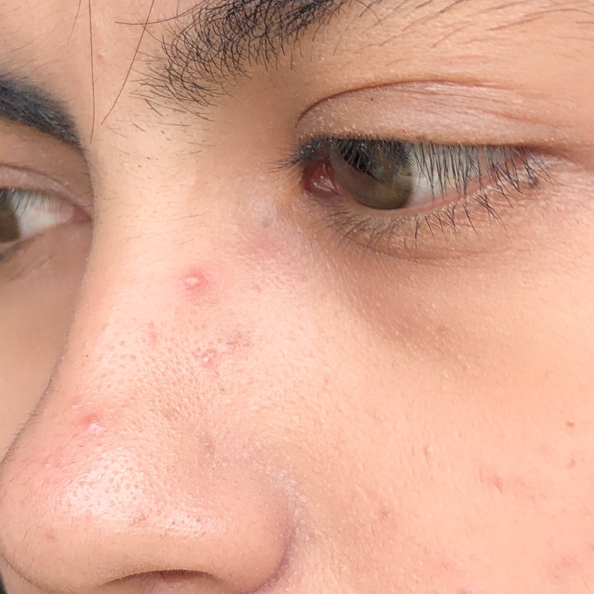 cuaeu's tweet photo. Akhirnya ngerti kenapa skin barrier yang lagi ngamuk gak bisa dipaksa pakai skincare yang "keras"😭

Pas muka lagi breakout + kekeringan, yang paling dibutuhin ternyata cuma skincare yang bisa nenangin kulit🥰😚
