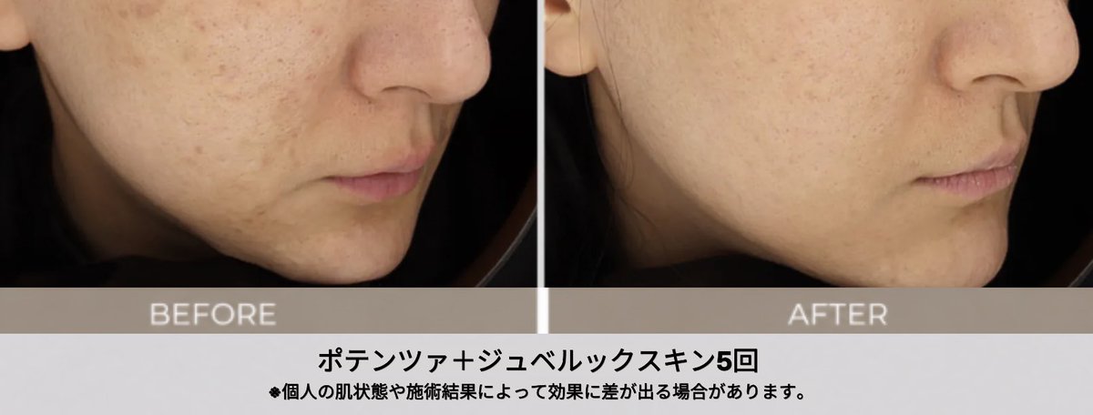 Doctors_MD_jp's tweet photo. 凹凸が目立たなくなり、お肌全体のキメが細かく整ってトーンアップした印象に💚

コラーゲン生成を促す組み合わせなので、内側から押し上げるようなハリ感が期待できます✨

肌質を根本から変えたい方は、ぜひ一度ご相談ください💡

お問い合わせ : https://t.co/Zc5mur3jvY https://t.co/Pjy6XMM9XY