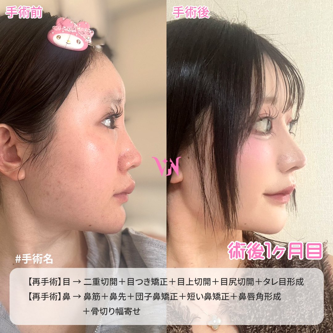 vannypsjp's tweet photo. 💖バンニ美容外科　症例写真💖

🔸手術内容🔸
【目の再手術】 二重切開＋目つき矯正＋目上切開＋目尻切開(靱帯移動含み)＋タレ目形成(＝目下切開)
【鼻の再手術】 鼻筋(軟骨)＋鼻先(軟骨)＋団子鼻矯正＋短い鼻矯正＋鼻唇角形成＋骨切り幅寄せ

『目元と鼻を同時に整えることで、お顔全体の調和がアップ！
目元は自然なぱっちり感を、鼻はお顔に合った高さとラインをデザインし、ナチュラルでありながらしっかりと変化を感じられる仕上がりになりました。
術後1ヶ月のためまだ完成ではありませんが、今後さらに馴染んでいきます💗』

お問い合わせや施術予約は公式LINEまで💌
https://t.co/4O2j3YKIPS 

ホームページ 
https://t.co/g33AhhATGw

#韓国整形 #二重整形 #二重再手術 #自然癒着 #二重切開 #目つき矯正 #眼瞼下垂 #目上切開 #目頭切開 #目尻切開 #タレ目切開 #目下切開 #額挙上 #鼻整形 #鼻再手術 #鼻筋 #鼻先 #団子鼻矯正 #鷲鼻矯正 #低い鼻矯正 #長い鼻矯正 #短い鼻矯正 #鼻唇角矯正 #小鼻縮小 #機能鼻手術 #下鼻甲介 #鼻中隔湾曲症 #クリニック