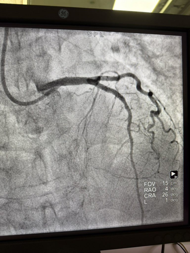 mmamas1973's tweet photo. First Primary of the day and a story of delays. 

Delayed presentation and admitted to another unit for stemi. Stayed there for a day and transferred urgently this morning. Was in pulmonary oedema. Remarkably anterior wall was still working and she had R waves on ECG

Primary PCI- @terumo_jp sheath, @BiosensorsLtd stents. Without the generous donations from our industry partners this woman would have been treated with bedrest. 
Fantastic to work with a great Ethiopian team under difficult circumstances. 

@HeartAEthiopia making real impact. @TTelila @drmerid @adane_petros8