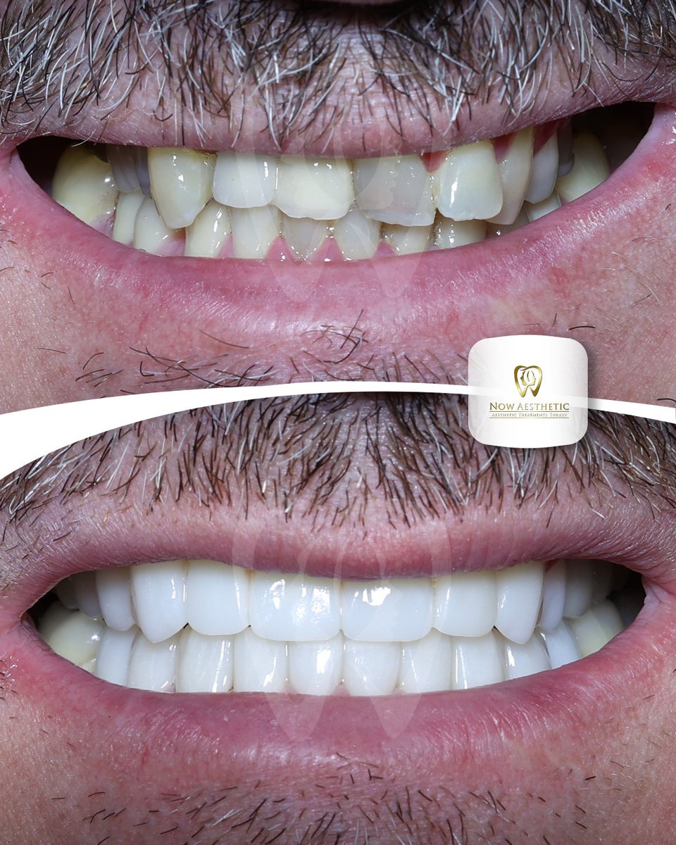 now_aesthetic's tweet photo. At Now Aesthetic, this zirconium veneer treatment delivered a significant and highly impactful smile transformation for our patient. 
#dantelaesthetic #teethwhitening #teethcrown #toothache #dentalimplants #dentalveneers #hollywoodsmile https://t.co/NMzyQ0gMuZ