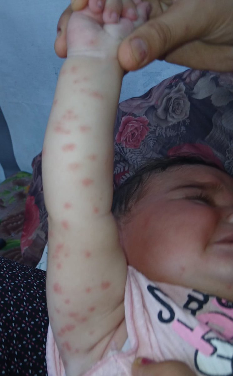 karam_alloh's tweet photo. My little girl suffers every day because of her skin condition, and I can't describe her tears as she cries in pain. We need to buy the medication. Please, donate even just €5; you could be the reason for easing the suffering of an innocent child who needs your support.🥺💔🙏 https://t.co/xpGbyCloM2