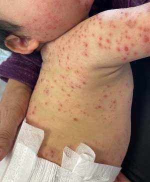 aepediatria's tweet photo. Eczema coxsackium en dermatitis atópica. Autora: Lara Margarida Navarro, entre otras.
Nueva Imágen en Pediatria de #AnalesDePediatría. Accede al artículo completo: 👇https://t.co/pwCRfJGzjS https://t.co/Q8LSJwELoN