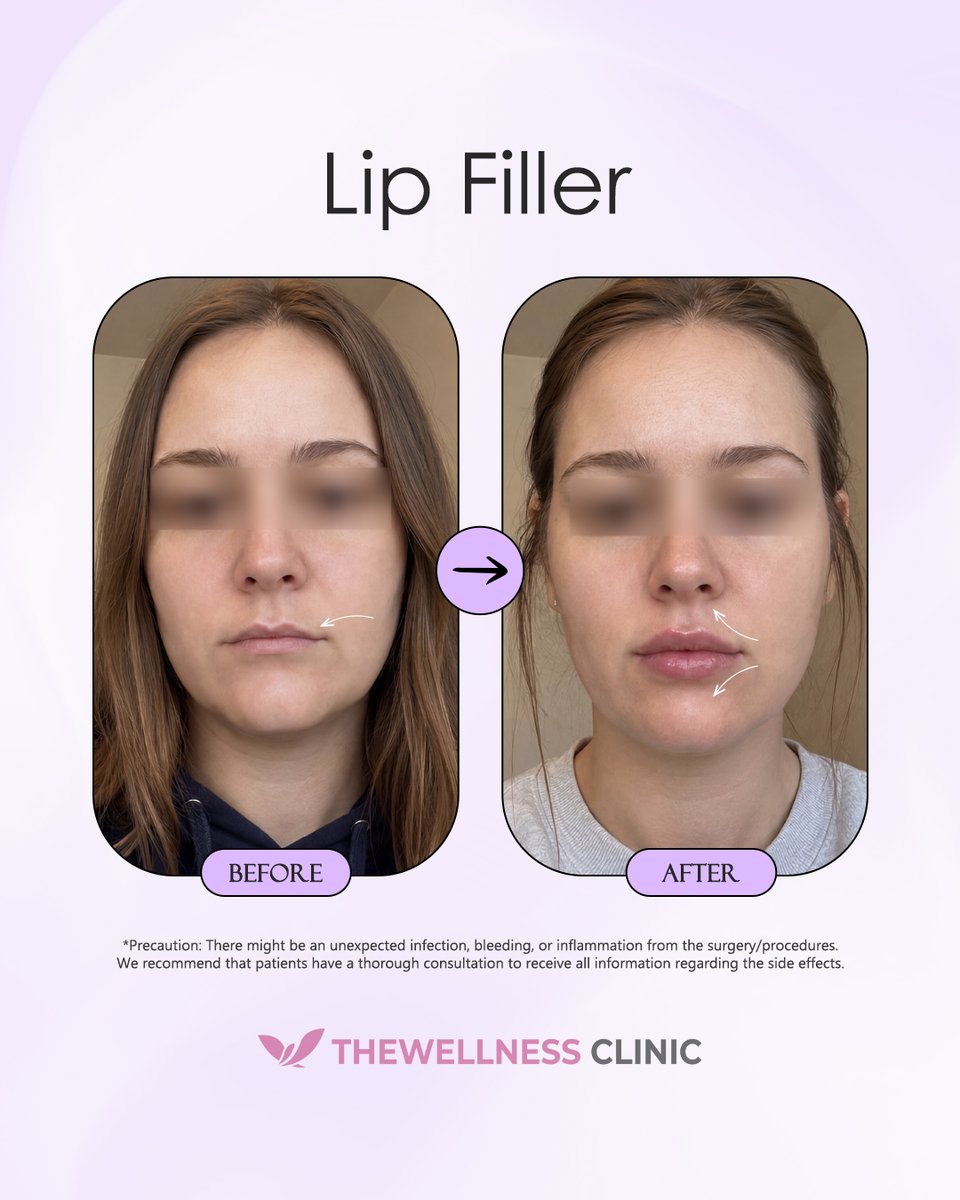 thewellnessen's tweet photo. Defining the Cupid's Bow &amp; Lifting Smile Lines💋

Define your perfect smile! See how premium lip filler accentuates the central peak of your Cupid's bow, adds balanced vertical volume, and gently elevates the outer corners for a naturally refreshed, youthfully plush expression!👇 https://t.co/r9973ogMMr