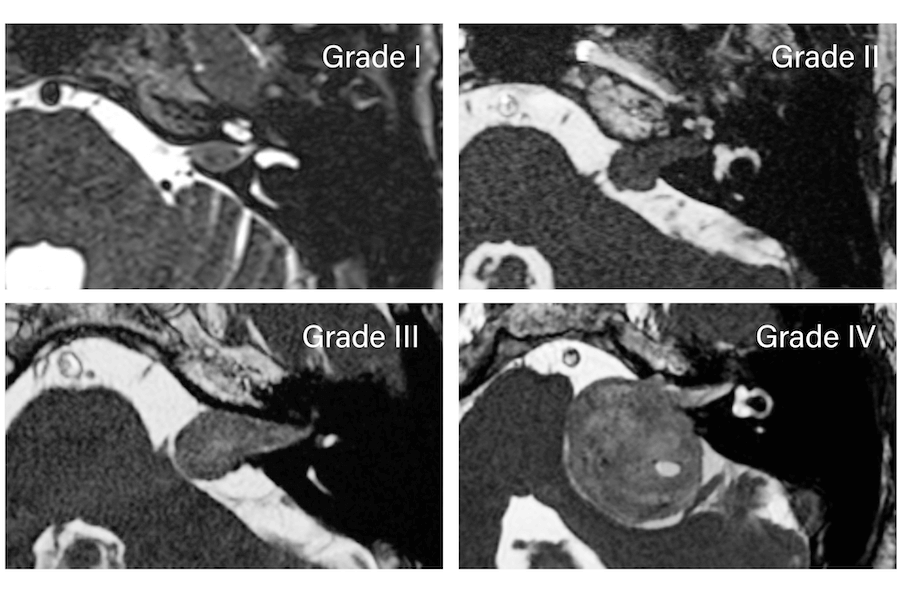 DocNavarrow's tweet photo. 💡The Koos classification grades vestibular schwannomas by their extension and relationship to the brainstem:

I: intracanalicular
II: extends into the CPA
III: contacts the brainstem
IV: displaces the brainstem

🔗https://t.co/hRGPEk6LDL https://t.co/cYFm5kux7W