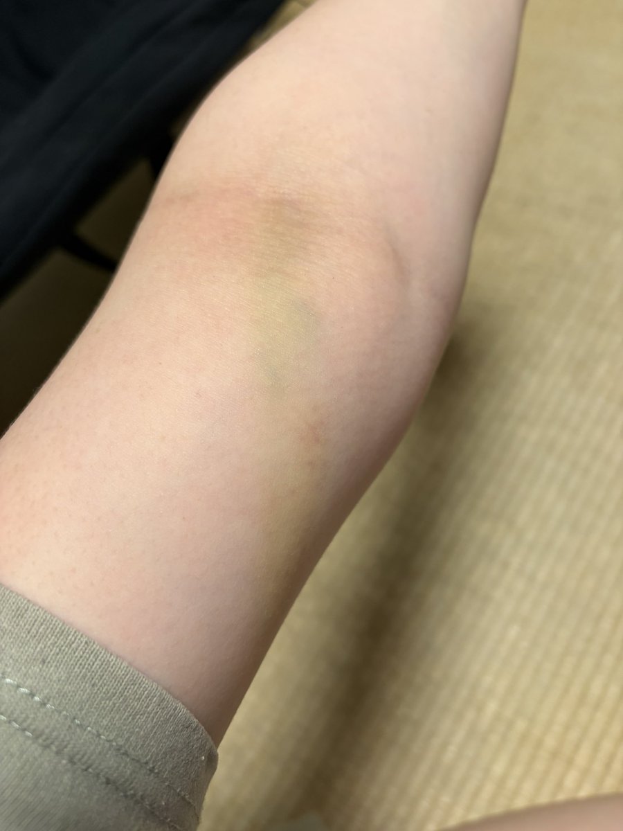 asagipeony's tweet photo. なんか二の腕の内側？に、斜めに1本の筋みたいに痣ができてるのだけれど全く覚えが無さすぎて怖い
縄跡みたいな痣なのだけれど縛った覚えもないし触ると結構痛い
なんなんだ
写真だと分かりづらいな https://t.co/jhY56vmeWI