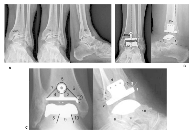 jbjs's tweet photo. "SALTO TALARIS Total Ankle Arthroplasty at a Minimum of 10 Years of Follow-up" by Sadoun et al.
Read the full article π https://t.co/R2AnkVi9pn
#JBJS https://t.co/21eXPjsKnr