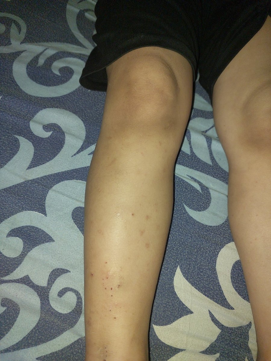 wdmr28280815's tweet photo. Dear friends, I implore you to help me provide healthy food for my son, Mazen. He is suffering from malnutrition and a severely weakened immune system. My daughter, Massa is also suffering from skin problems due to the extreme heat inside the tent
Please🙏
https://t.co/OJ4FRArqSy https://t.co/zQL1EL7Izg